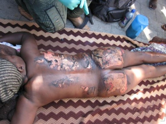 Quemaduras en la piel de un niño sobreviviente del sismo, en Haití, a tres semanas del terremoto, el 1 de febrero de 2010. AIN FOTO/Armando PEÑA GUERRA