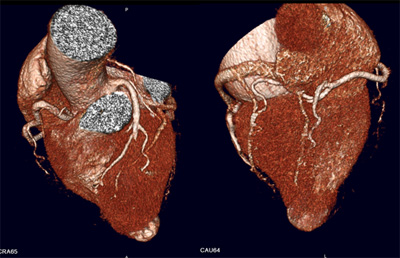 Imágenes de Coronariografía por Tomografía multicortes.
