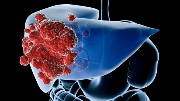 Un virus podría acabar con el cáncer de hígado