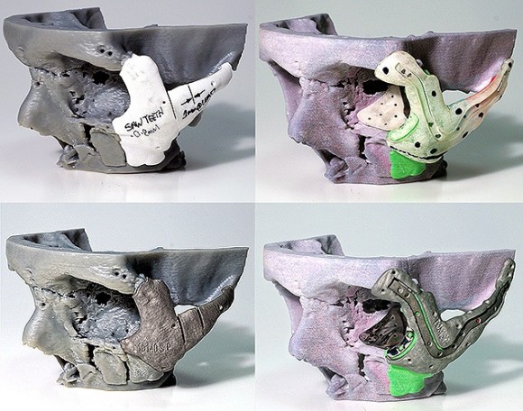 Reconstrucción craneal a través del uso de la impresora 3D. Foto: AFP