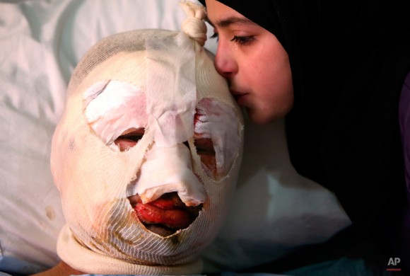 Fátima llora mientras ella besa a su padre herido, Ahmad al-Messmar, de 40 años, que resultó herido cuando un coche bomba mortal estalló cerca de una ... - ap471603279564_6-580x390